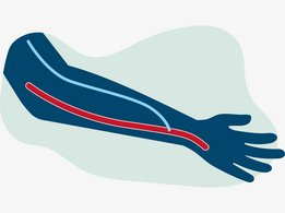 arteriovenózus fisztula 